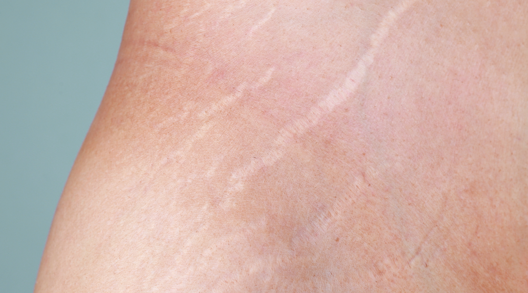 Close-up of stretch marks on skin showing red and white lines.